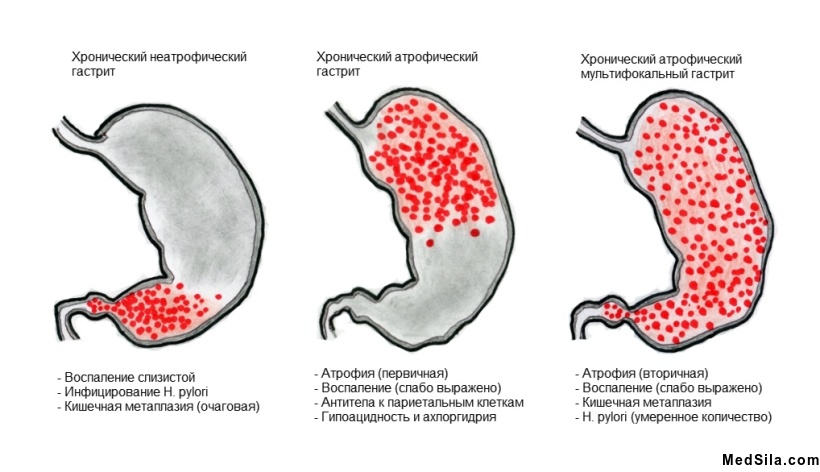 Классификация хронического гастрита